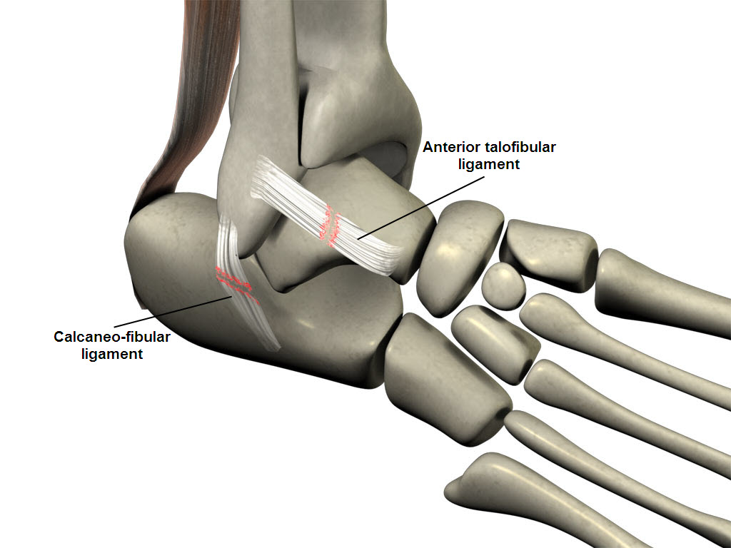 ankle_sprain.png, ankle sprain ligament damage